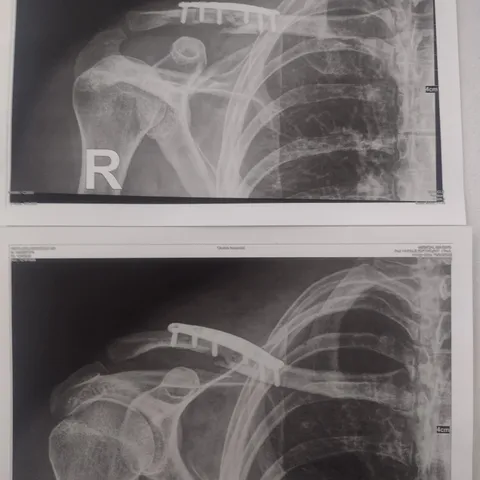 Xray of the fixed clavicle