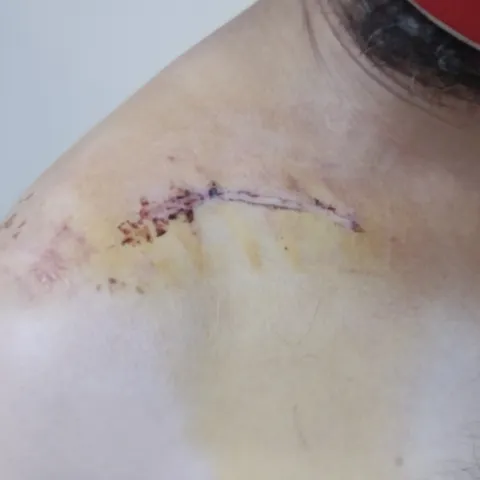 Post surgery: stitches after 4 days